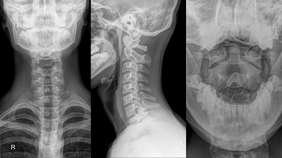 X-ray of female hips, pelvis and spine