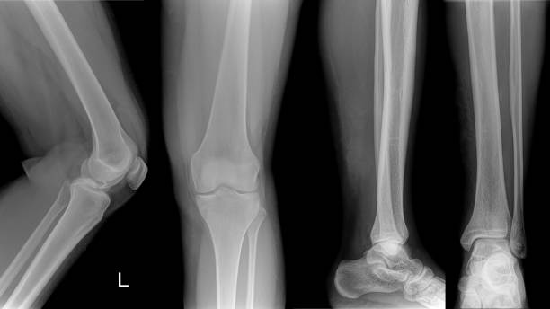 pellicola a raggi x della gamba e del ginocchio di un paziente adulto. - macchina per radiografie foto e immagini stock