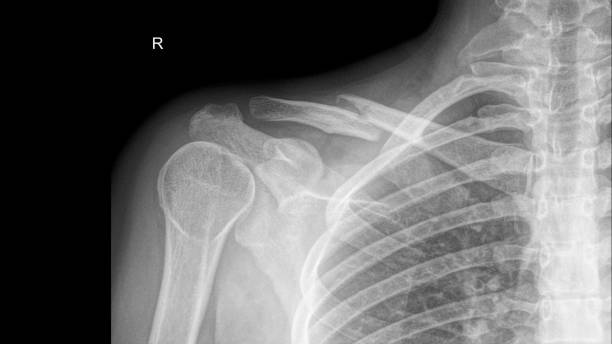 radiografia di una frattura della clavicola destra - busto ortopedico foto e immagini stock