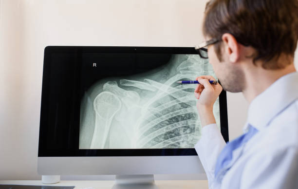 radiologist analyzing a patient x ray with a clavicle fracture. - sleutelbeen-fotos stockfoto's en -beelden
