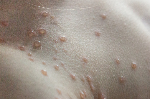 Ampollas de vesícula de varicela en el hombro y el pecho de un niño photo