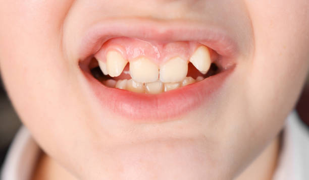 nahaufnahme des mundes eines kindes mit fehlpositionierten zähnen. - fehlbiss stock-fotos und bilder