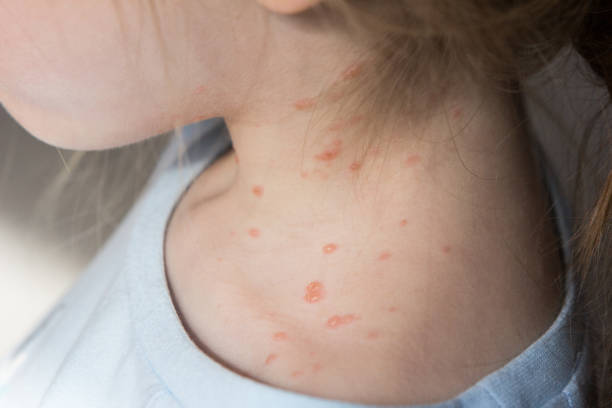 Chickenpox on a child's neck and collarbone Chickenpox is an infectious disease. It causes a spotty itchy rash on the body. Some people have a few spots while others can have a lot. The spots fill with a fluid under the top layer of the skin creating bubble-like sac vesicles. These blisters eventually turn into scabs. pox stock pictures, royalty-free photos & images