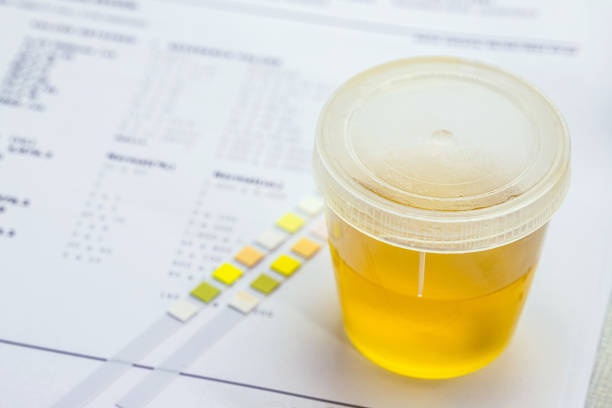 urine vial in laboratory, toxicology or routine examination stock photo