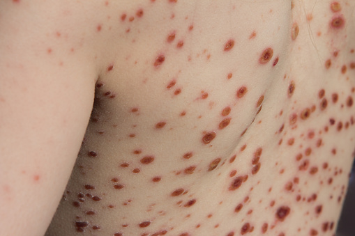 Costras de varicela en el omóplato de un niño photo