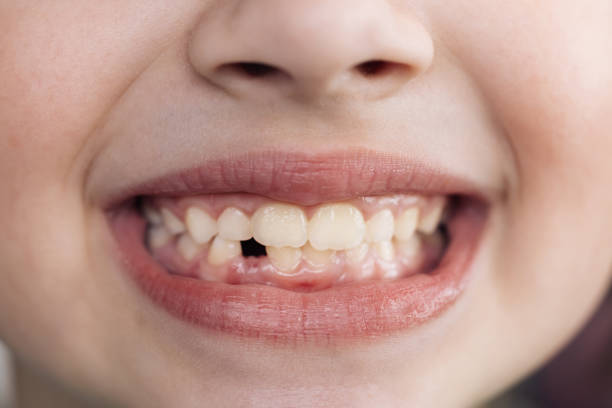 sorriso ravvicinato di una bambina. una bella bambina di 7-8 anni ha perso i denti da latte. perdita di denti da latte, sostituzione dei denti permanenti. i bambini sono odontoiatria - toothless smile foto e immagini stock