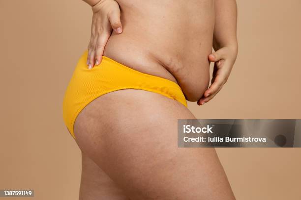 Cropped Image Of Overweight Fat Woman Tummy Losing Weight Excess Fat In  Yellow Underwear Hiding Flabs Cellulite Diet Stock Photo - Download Image  Now - iStock