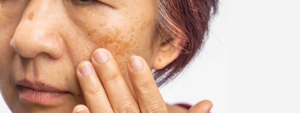 le donne in menopausa si preoccupano del melasma sul viso. - pantaloni aderenti foto e immagini stock