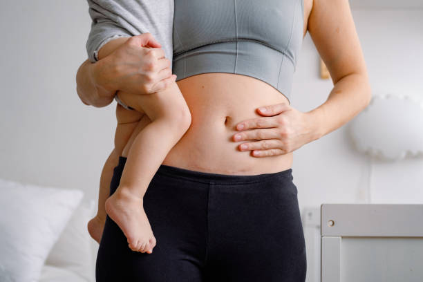 nahaufnahme eines bauches mit narbe aus kaiserschnitt. eine frau mit einem baby, das ihren unvollkommenen körper zeigt. ein bauch mit narbe aus dem kaiserschnitt. - baby beauty beautiful the human body stock-fotos und bilder