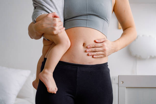 cセクションからの傷跡のある腹のクローズアップ。赤ん坊を抱く女性が不完全な体を見せている。カエサリアのセクションからの瘢痕を持つ腹部。 - 出産 ストックフォトと画像