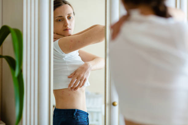 Woman looks to an itching rash on dry flaky irritatng skin of psoriasis or eczema Woman looks in to a mirror an itching rash on dry flaky skin, as in the psoriasis, eczema and other diseases psoriasis stock pictures, royalty-free photos & images