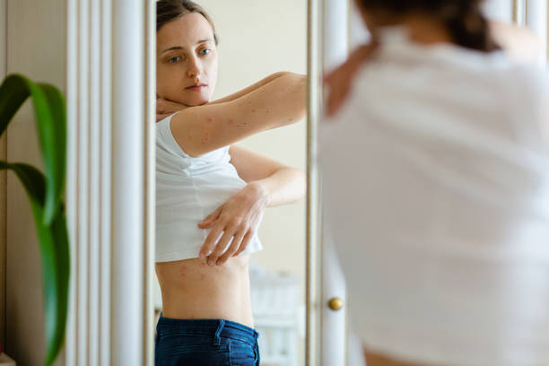 Woman looks to an itching rash on dry flaky irritatng skin of psoriasis or eczema Woman looks in to a mirror an itching rash on dry flaky skin, as in the psoriasis, eczema and other diseases photo psoriasis stock pictures, royalty-free photos & images