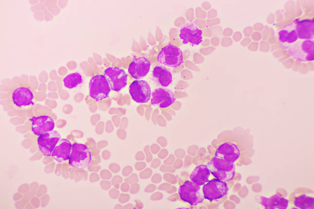 istock Acute promyelocytic leukemia cells 1387831521