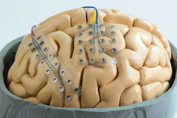 elettrodo a griglia subdurale per la registrazione delle onde cerebrali sul modello cerebrale - eeg epilepsy science electrode foto e immagini stock