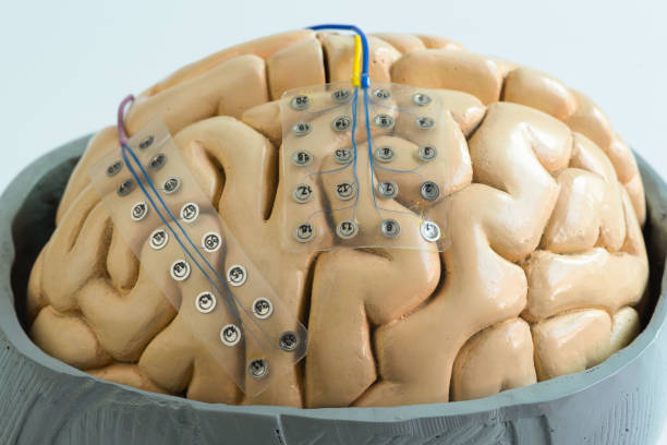 subdural grid electrode for brain waves recording on the brain model - eeg epilepsy science electrode imagens e fotografias de stock