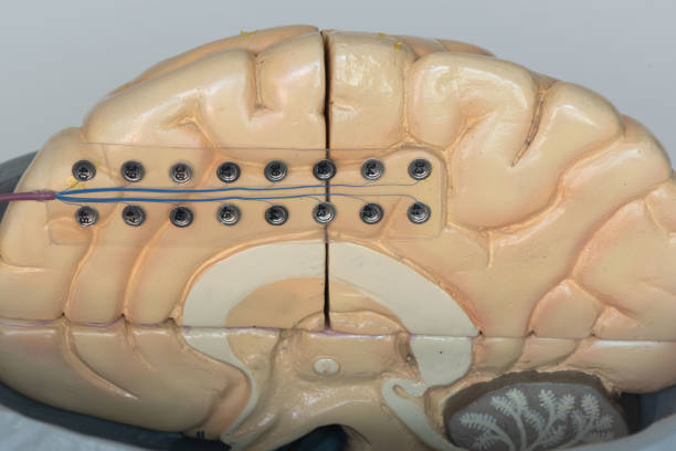 subdurale elektrode auf der medialen seite der gehirnhälfte - eeg epilepsy science electrode stock-fotos und bilder