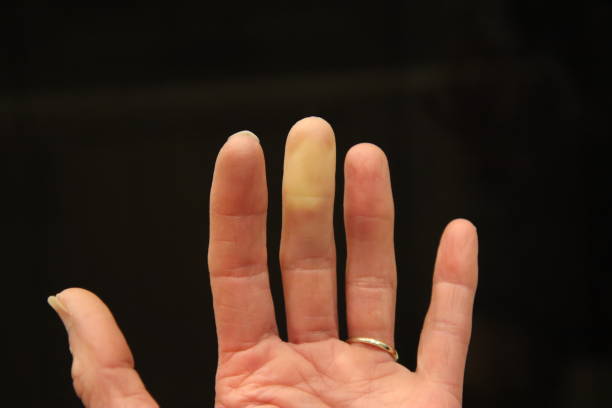 istock Raynaud’s Syndrome Phenomenon hand and fingers. 1387923122