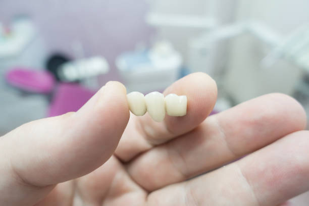 zahnkeramik metallbrücken in den händen - laboratory dentures dental hygiene human teeth stock-fotos und bilder