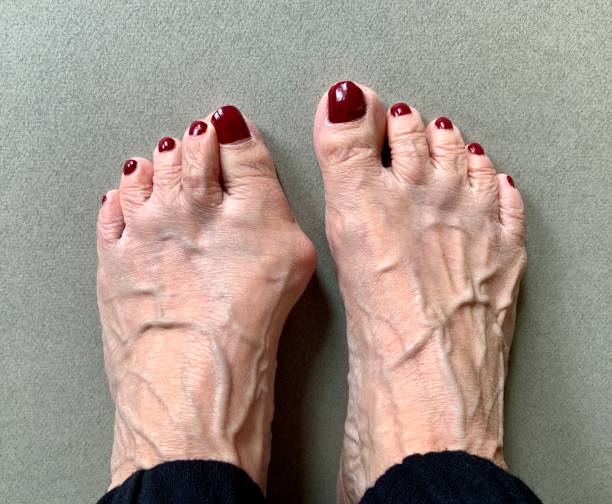 Senior Woman’s Foot with Bunion stock photo