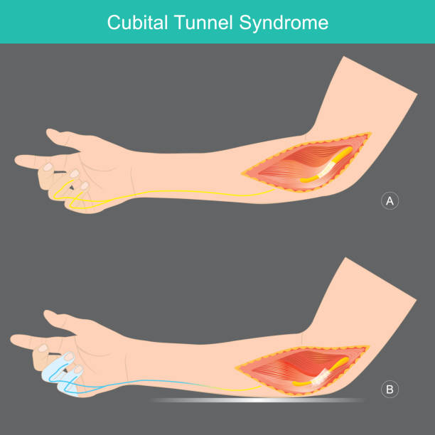 Cubital Tunnel Syndrome. A condition that involves pressure or stretching of the ulnar nerve in arms which can cause numbness or tingling in the ring and small fingers. Cubital Tunnel Syndrome. A condition that involves pressure or stretching of the ulnar nerve in arms which can cause numbness or tingling in the ring and small fingers. forearm stock illustrations