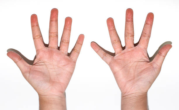 istock skin peeling on hands on white background. 1388138665