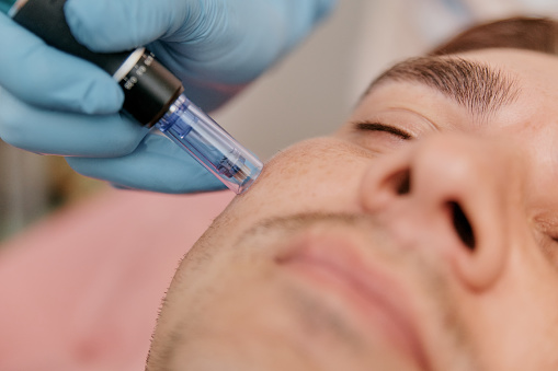 Terapia de inducción de colágeno Microagujas Para el rostro de un hombre europeo de cerca photo