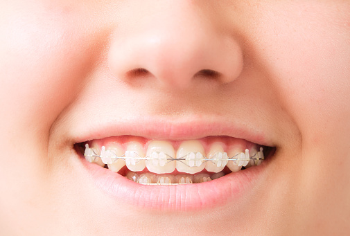 boca sonriente con alineador dental photo