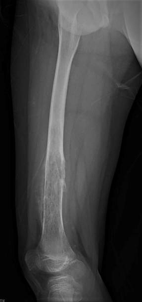 istock x-ray of aggressive bone tumor osteosarcoma 1388391098