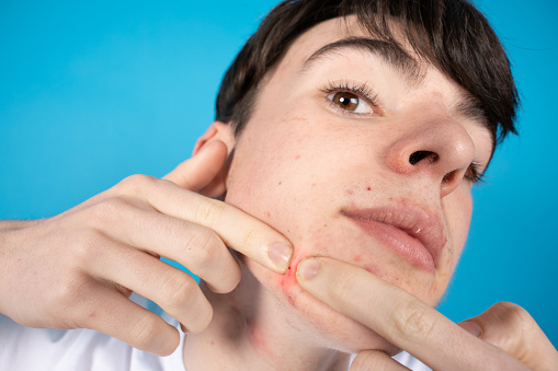 Closeup of teenager exploding a pimple. Dermatology and acne problems in adolescence concept.