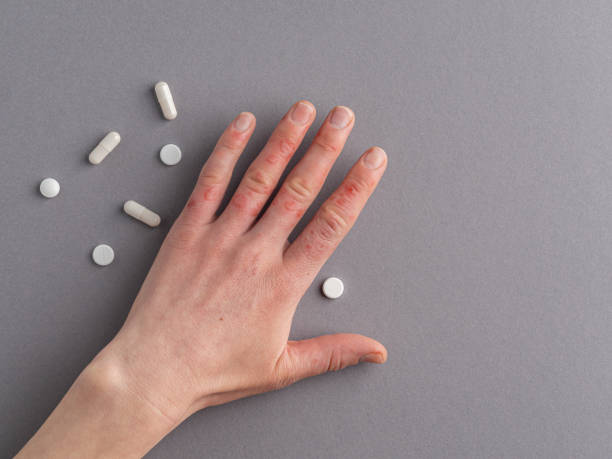 Hands of woman with dermatology disease (eczema, urticaria, dermatitis, erythema, blistering or infection) and white drugs and pills to treat it. Gray background, copy space. Medical treatment and healing concept. erythema nodosum stock pictures, royalty-free photos & images