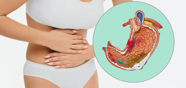 Ulcer and gastritis, treatment of stomach disease. Anatomical model of stomach with pathology over background woman with pain in stomach area stock photo
