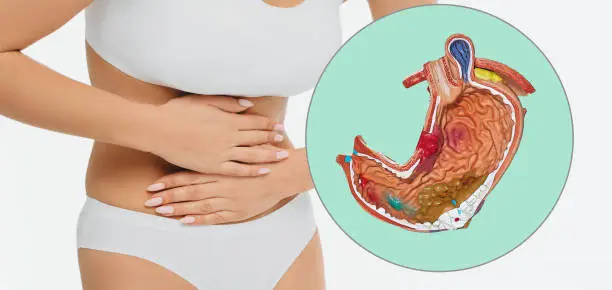 Photo of Ulcer and gastritis, treatment of stomach disease. Anatomical model of stomach with pathology over background woman with pain in stomach area