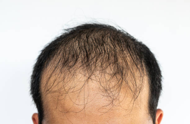 istock Close up of Asian male pattern baldness. 1388679348