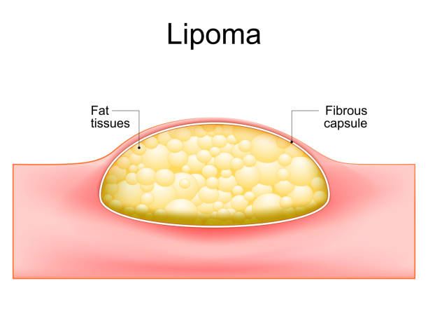 lipom. querschnitt einer menschlichen haut. - lipoma stock-grafiken, -clipart, -cartoons und -symbole