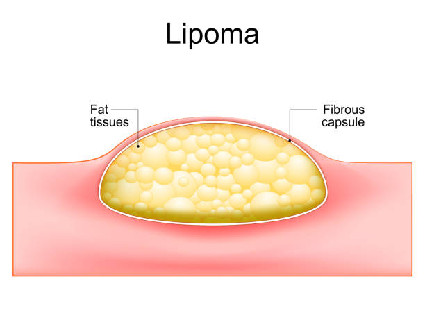 Lipoma. Cross section of a human skin. vector art illustration