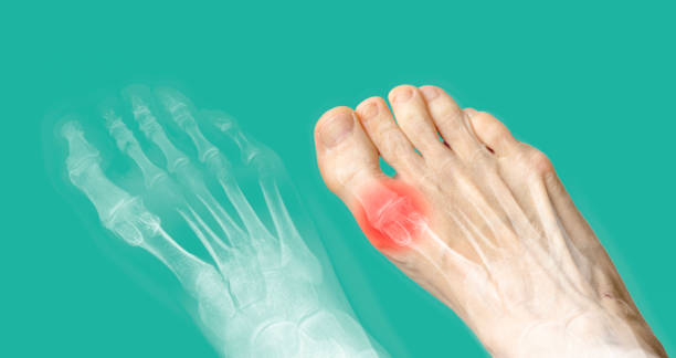 istock X-ray and the same foot with red pain. Rheumatoid arthritis. Osteoarthritis 1388784692