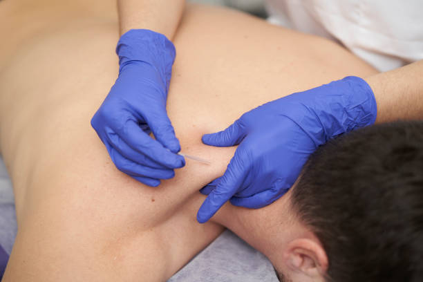 istock physiotherapist treating an overload with dry needling 1388788069