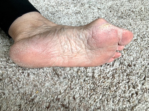 Senior woman’s imperfect foot