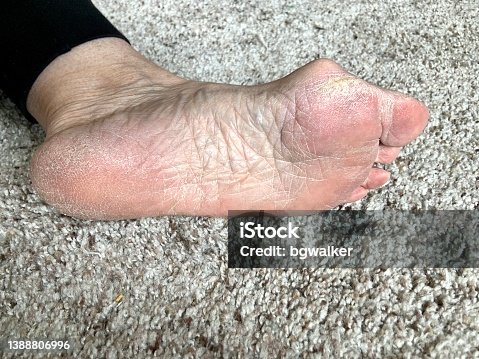 istock Senior Woman’s Foot with High Instep and Bunion 1388806996