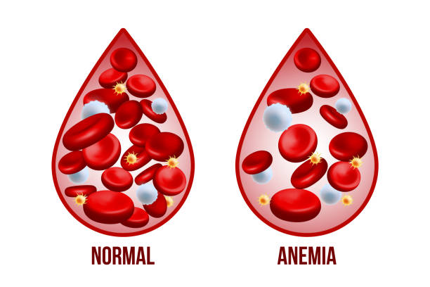 illustrazioni stock, clip art, cartoni animati e icone di tendenza di anemia da carenza di ferro. la differenza di anemia quantità di globuli rossi e normale. - anemia