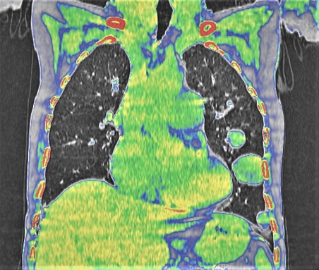 axial, mediastinum window, chest CT scan of a 50  -year-old female with dyspneu  reveals multiple nodules  canon ball type  throughout the lungs, sugestive pulmonary metastasis.