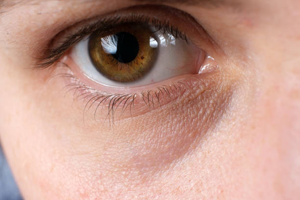 A macro photo of the human eye is a bruise under the eye, a tired look stock photo