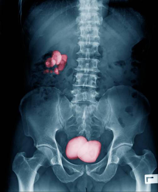 Renal calculus kidney stone and big blader stone stock photo