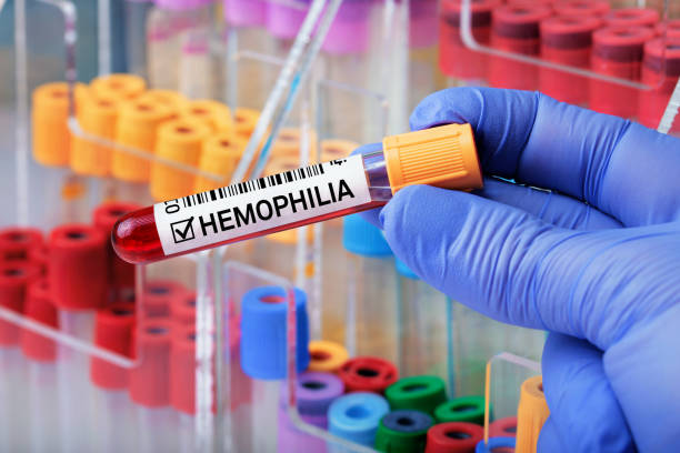 Blood sample with positive diagnosis of Hemophilia stock photo