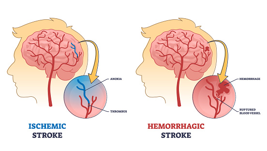Ischemic vs hemorrhagic head stroke anatomical comparison outline diagram. Labeled educational scheme with medical brain clot, ruptured blood vessel and anoxia after thrombus vector illustration.