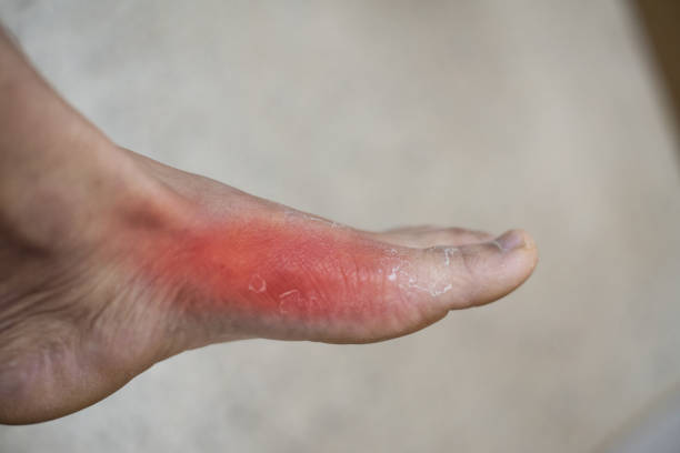 Close up Foot of pateint skin joint arthritis.