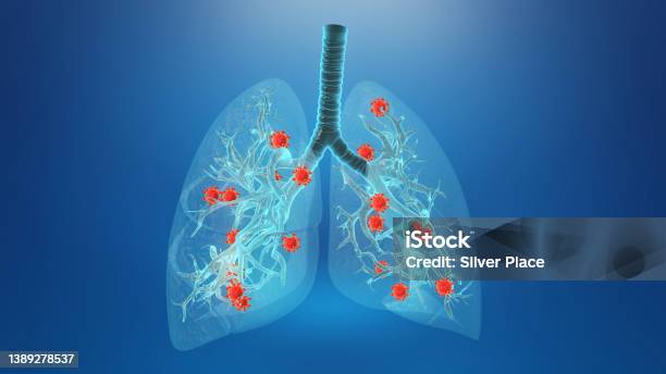 Coronavirus Infecting Human Lungs Background Stock Photo - Download Image Now - Lung, Fibrosis, Lung Infection