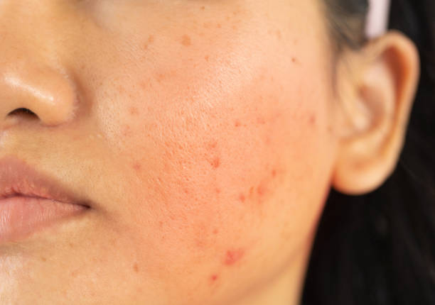 Close up of acne scars, dark spots, freckles, melasma of Asian woman or lady face. People problem. Adolescent Close up of acne scars, dark spots, freckles, melasma of Asian woman or lady face. People problem. Adolescent rosy cheeks stock pictures, royalty-free photos & images