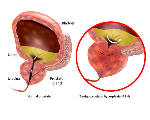 illustrations, cliparts, dessins animés et icônes de illustration médicale montrant une hyperplasie bénigne de la prostate hbp et une prostate normale. élargissement de la prostate - prostate gland