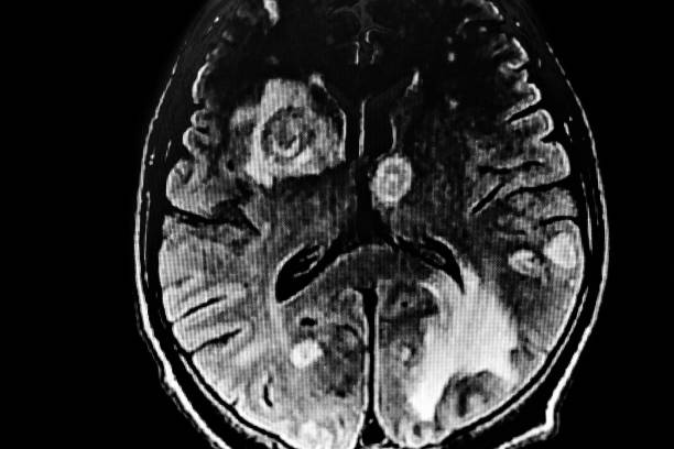 istock CAT SCAN with brain toxoplasmosis. 1389344971